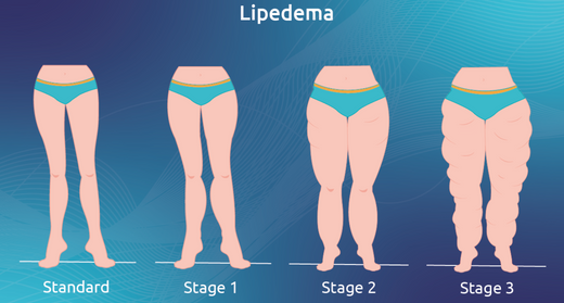 Lipoedema hastalığı nedir? Bacaklarda simetrik yağ birikimi gösteren kadın illüstrasyonu.